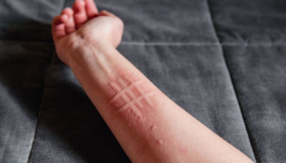 Living with Dermatographia: What to Know