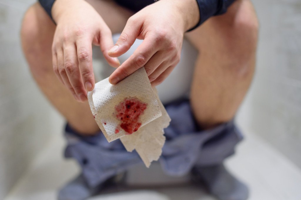 Is Bright Red Blood on Toilet Paper Always Hemorrhoids?