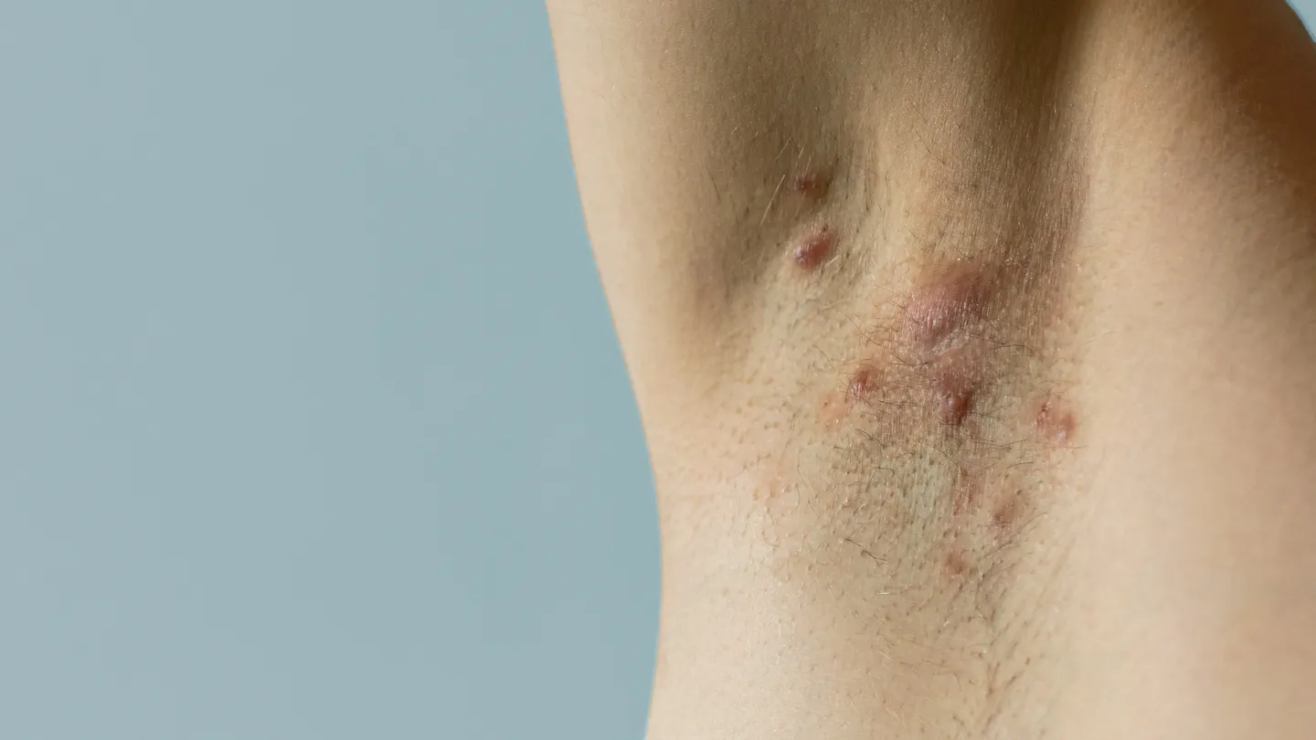 What Are The Early Warning Signs Of Hidradenitis Suppurativa?
