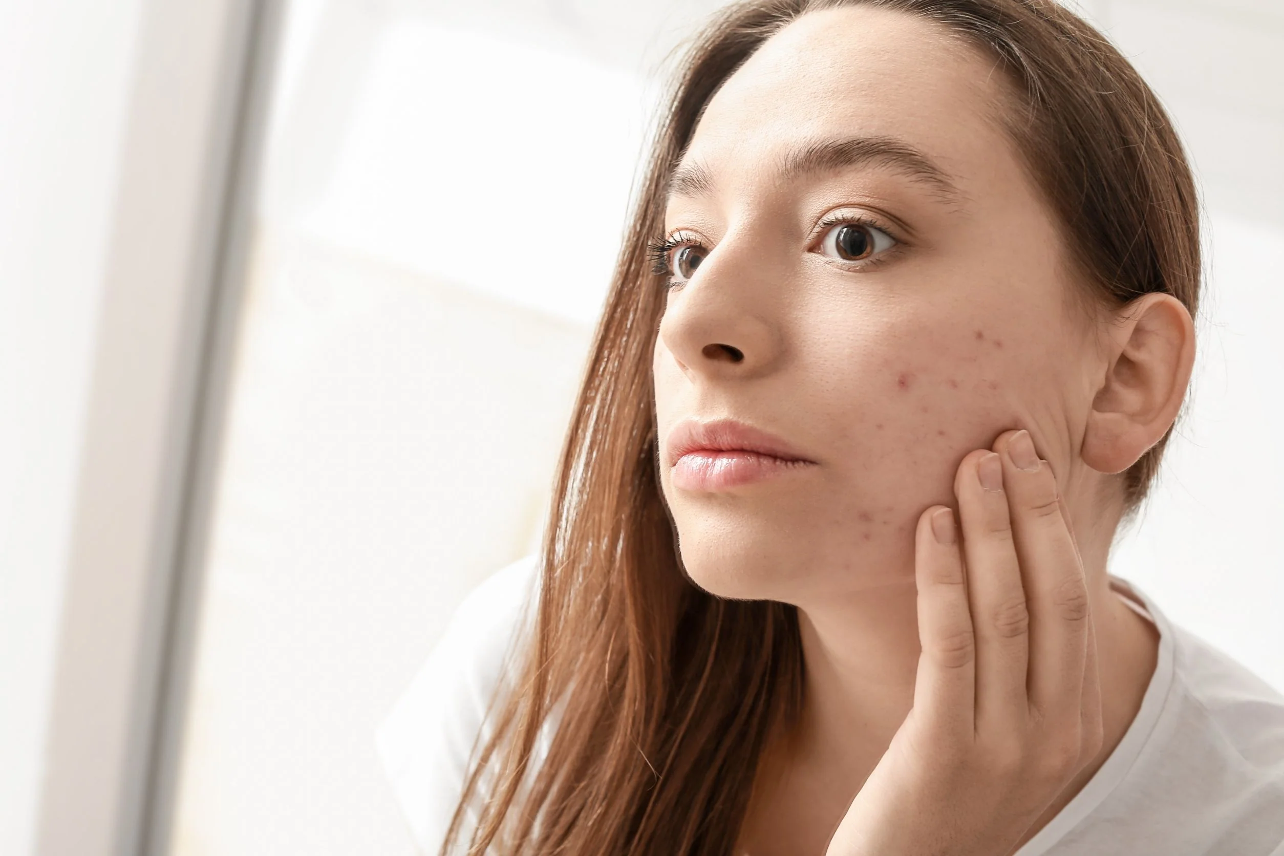 Does Zepbound Help With Acne?