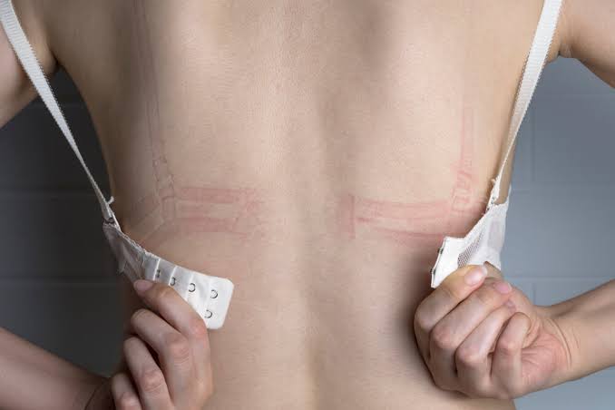 Does Wearing Tight Bras Affect Lymph Drainage?