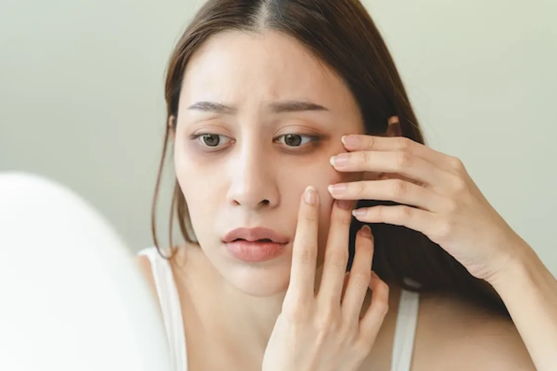 Why Do Dark Under-Eye Circles Stay Even After 8 Full Hours of Sleep?