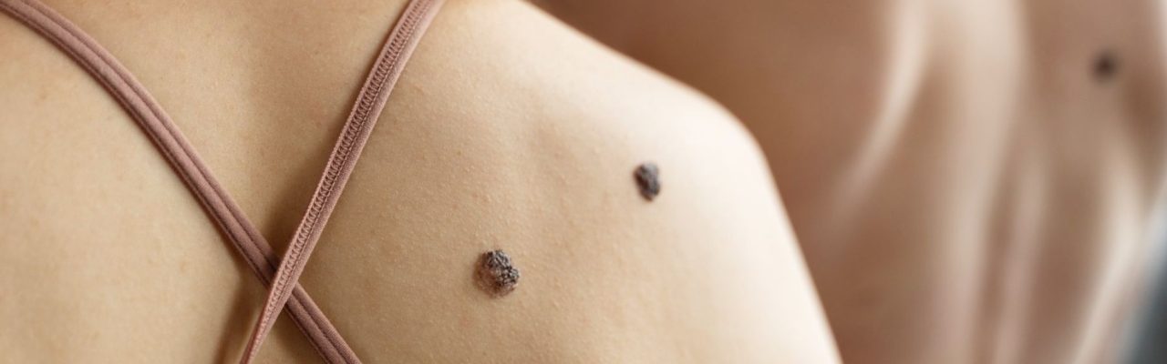 Do Warts Come Back After Removal?